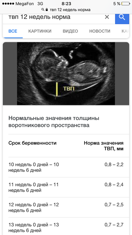 Толщина воротниковой. УЗИ норма ТВП 12 недель беременности. ТВП норма в 13 недель беременности таблица. ТВП В 13 недель норма таблица по УЗИ. Толщина воротникового пространства 1 скрининг норма.