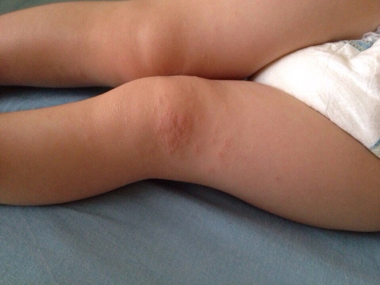 Сыпь на коленке