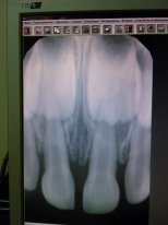 Почернел молочный зуб после травмы