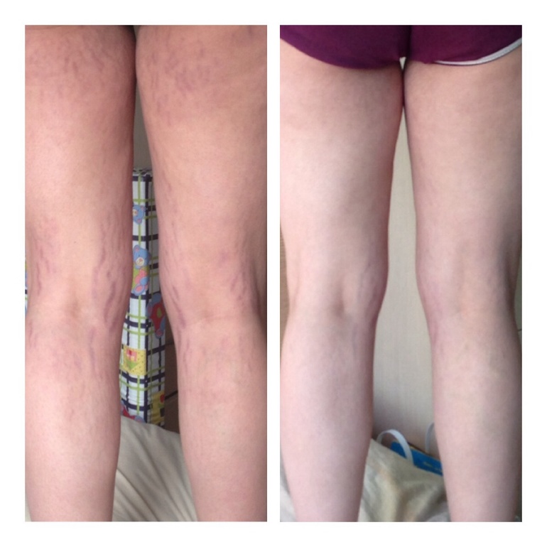 Как я избавлялась от растяжек часть 9. Дневник полосатой леди