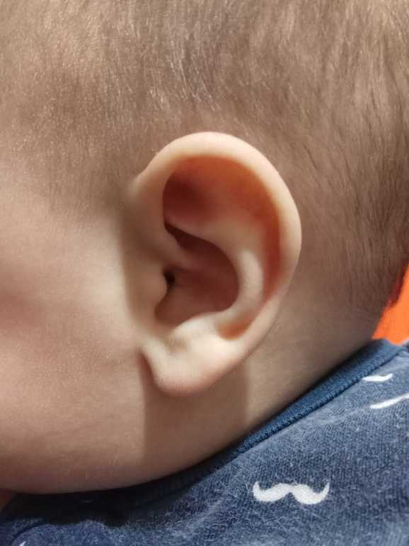 Почему уши разные. Микротия ушной раковины у новорожденного. Деформированные ушные раковины.