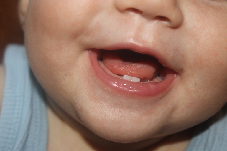 Стоматит или молочница?