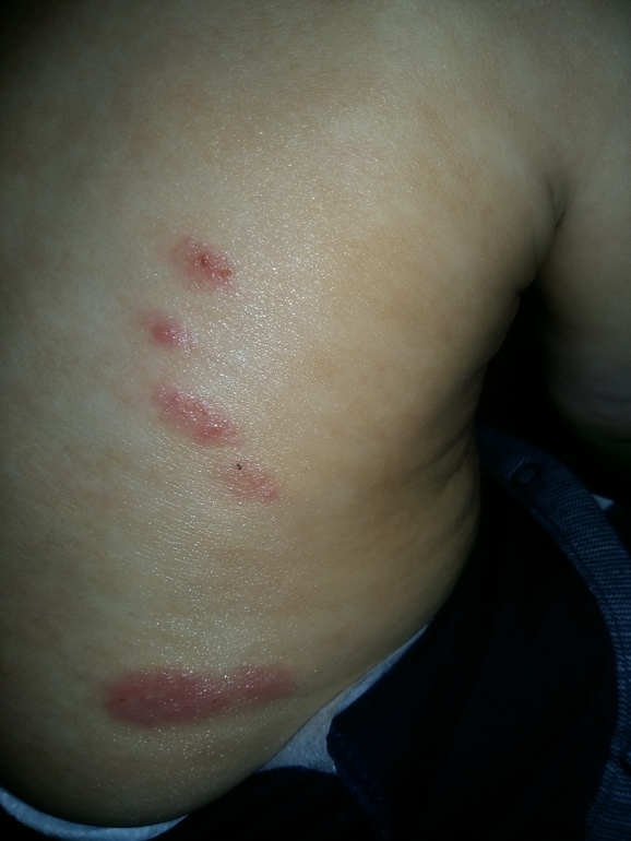 Аллергия запор лечения у детей thumbnail