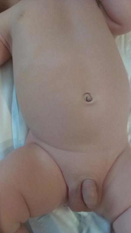 Потемнение на коже у грудничка