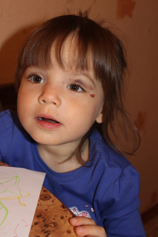 Тупой удар рядом с глазом