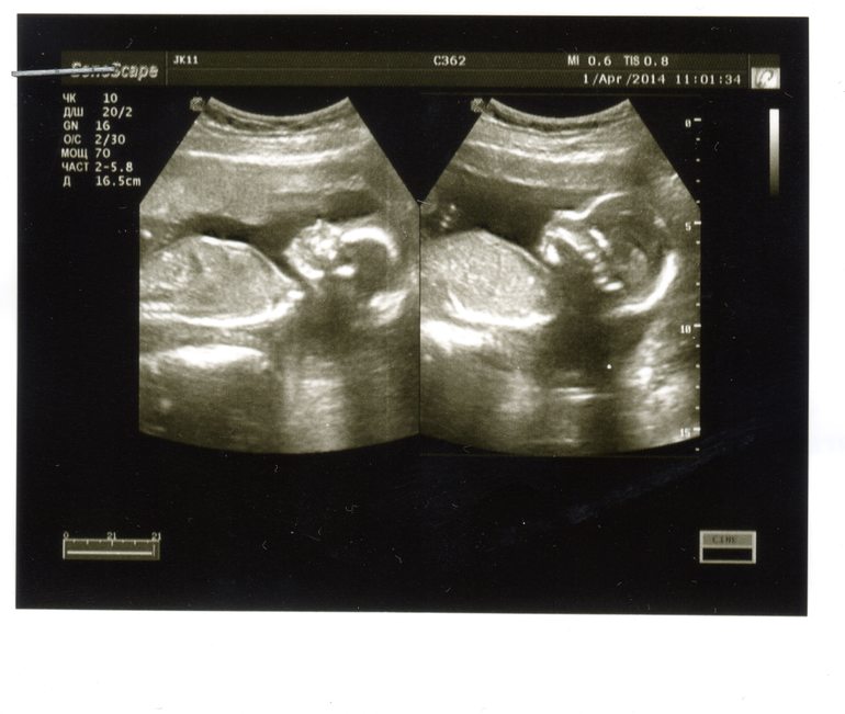 Второе УЗИ позади