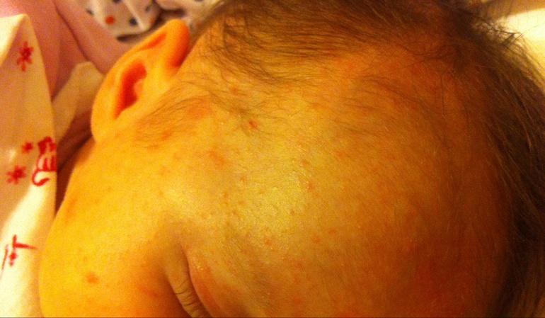 Потница или аллергия?