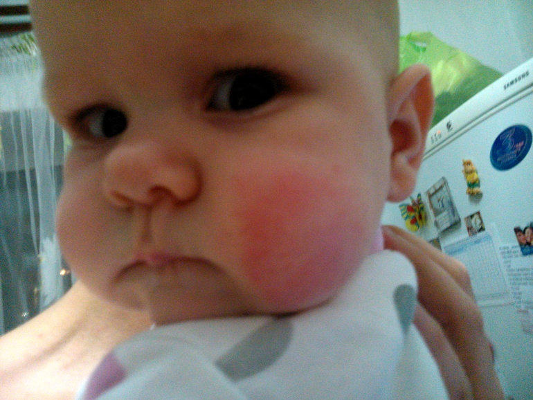 Аллергия высыпала!!!