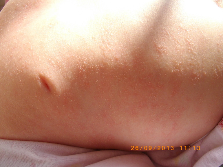 Сыпь....Может кто то знает что это такое, оно еще и шелушится....