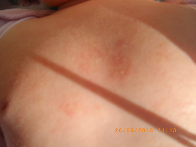 Сыпь....Может кто то знает что это такое, оно еще и шелушится....