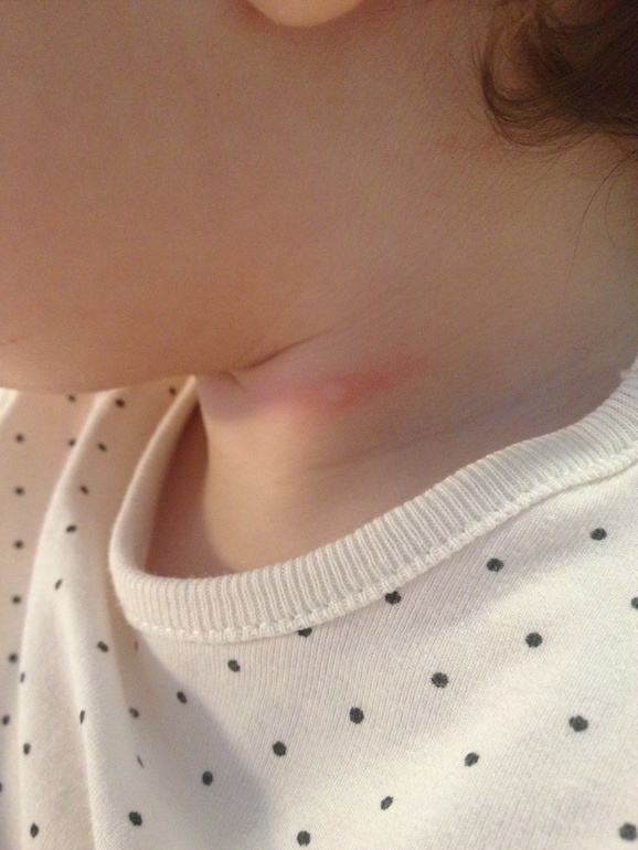 Девочки это что крапивница?