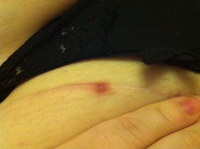 Шрам от шва