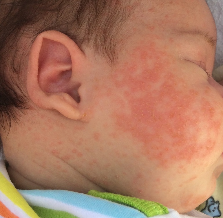Цветение или аллергия у новорожденных форум thumbnail